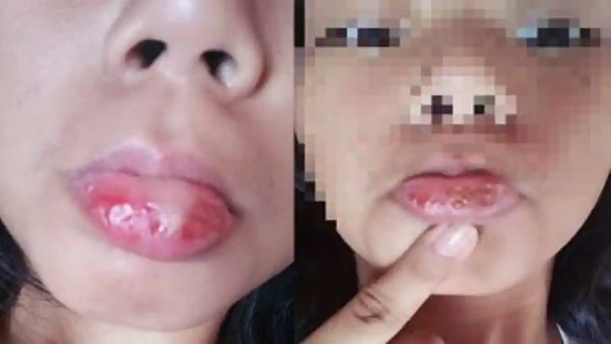 Hati-Hati! Anak ini Mengalami Hal Mengerikan Setelah Menuggunakan Kosmetik Murah