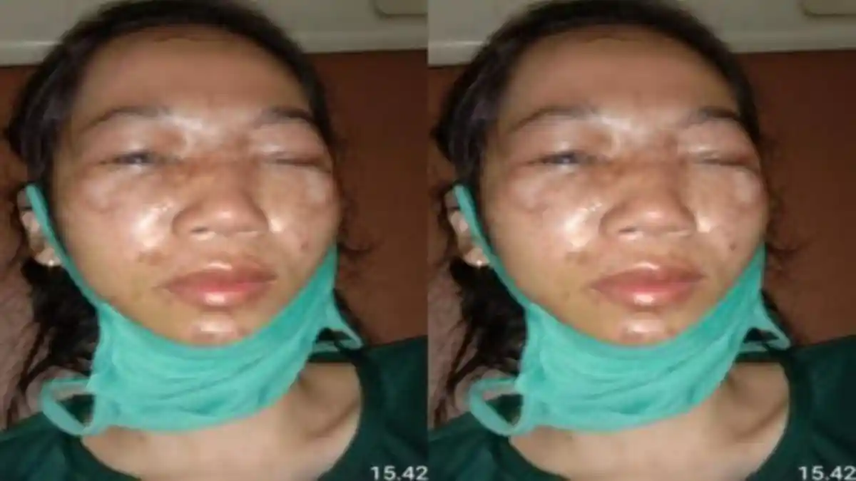 Cinta Ditolak Air Keras Disiramkan, Guru TK di Sumatera Selatan Terancam Kebutaan