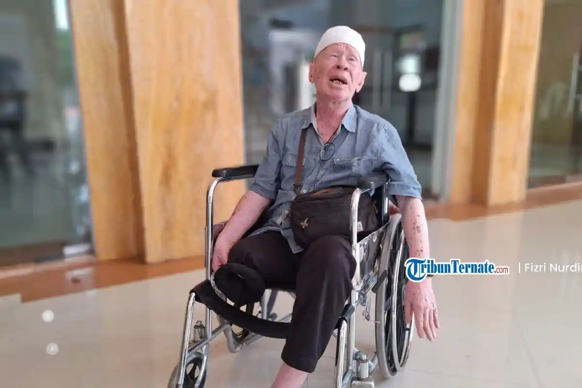 Sarifudin Tagih Janji Kaki Palsu, Dinsos Maluku Utara: Harus Kolektif Minimal 5 Orang