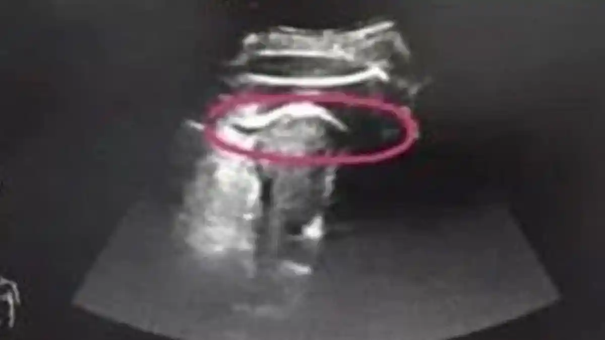 Pakai USG, Janin Ini Menendang Keras Rahim Ibunya Hingga Kakinya Keluar, Dokter pun Panik