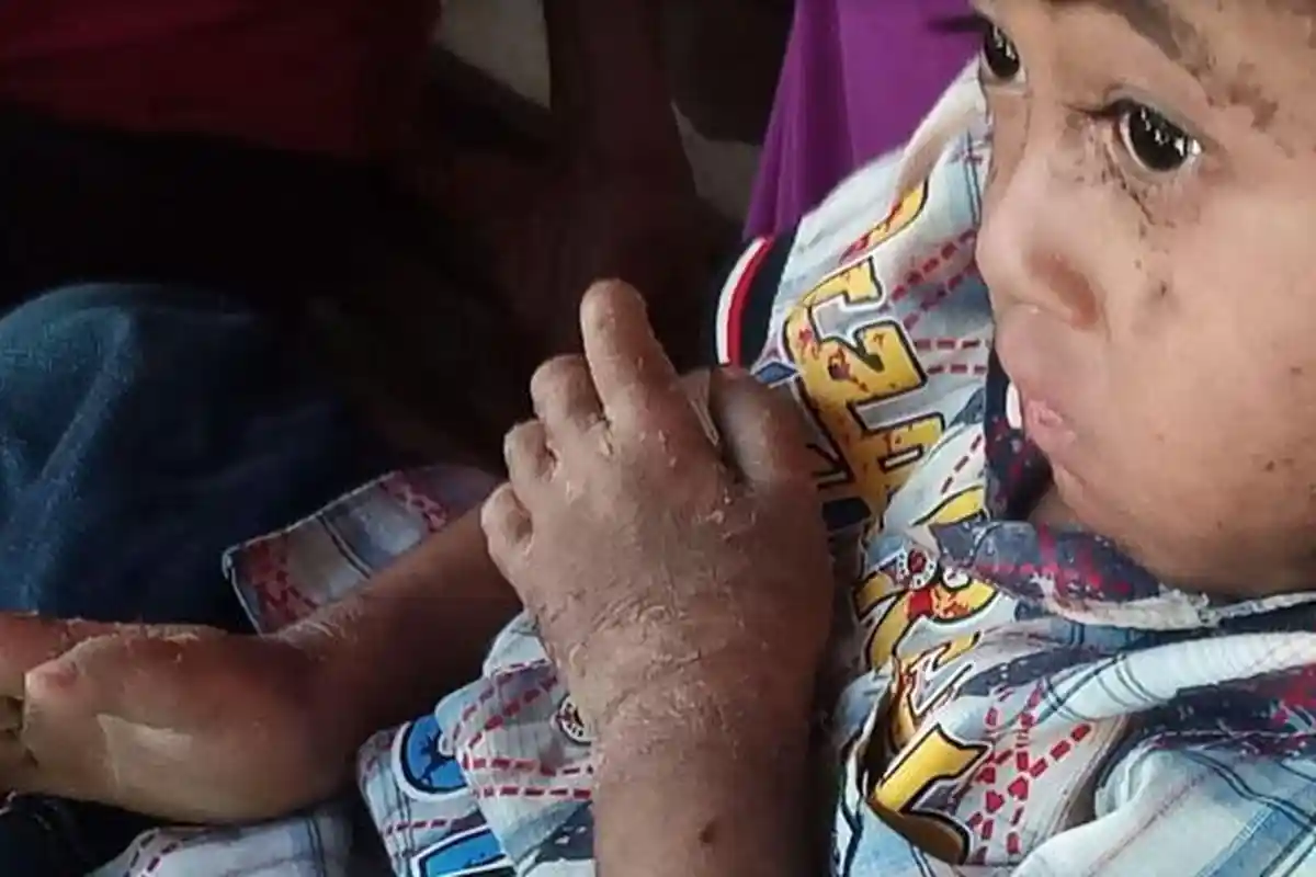 Penyebab Balita Idap Penyakit Langka, Dinkes Madiun Pastikan Pengobatan hingga Tingkat Bawah