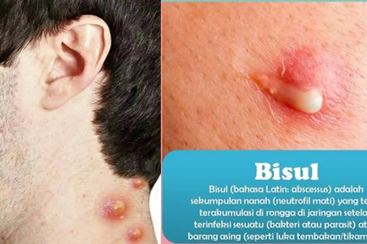 Cara Mengobati Bisul Tanpa Harus Ke Dokter, Begini Langkahnya Hingga Bersih dan Bisul Langsung Pecah