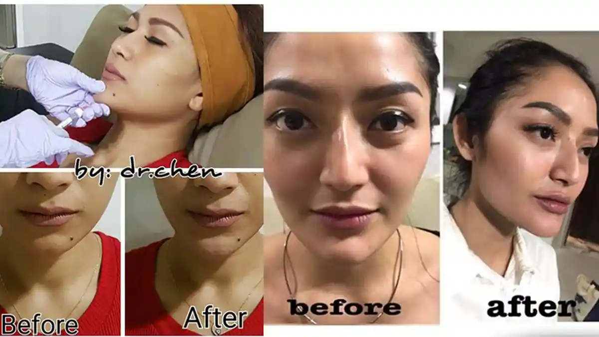 5 Seleb ini Terang-terangan Lakukan Botox dan Filler, Jadi Cantik atau Aneh?