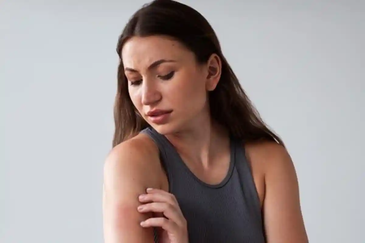 Biduran Sering Kambuh Bisa Diatasi dengan Bahan Herbal, Ini Penjelasan Dokter