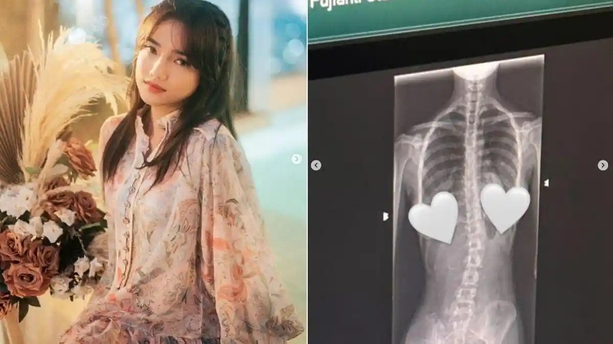 Fuji Idap Penyakit Skoliosis, Thariq Halilintar Berikan Perhatian Manis