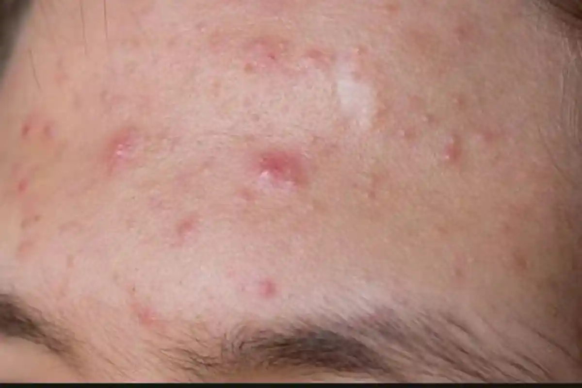 Miliki Jerawat Pasir di Wajah? Atasi dengan Bahan Ini