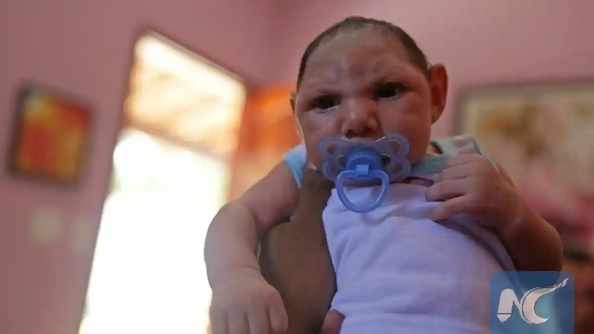 Kasus Mikrosefali Akibat Virus Zika Terjadi di Florida untuk Pertama Kali