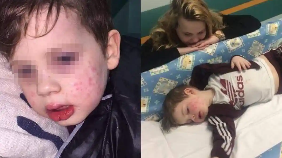 Balita Ini Nyaris Buta Lantaran Tertular Herpes Usai Dicium Kerabatnya
