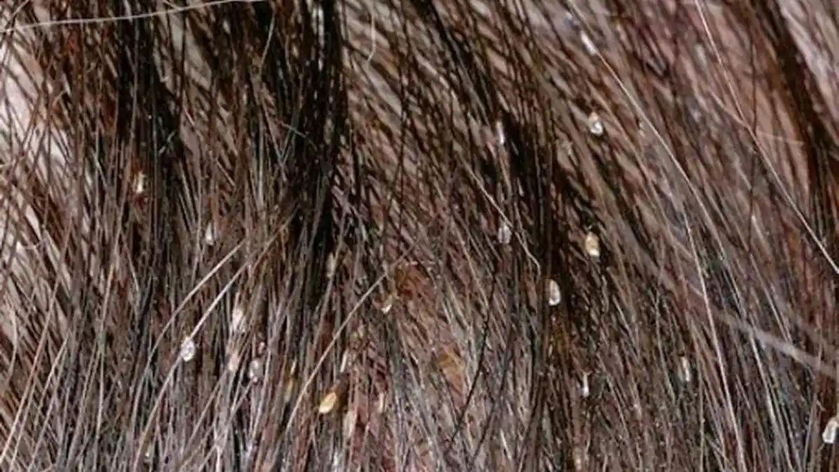 Cara Ampuh Basmi Kutu Rambut dan Telur-telurnya Secara Alami Tanpa Obat, Oleskan Minyak Kayu Putih!