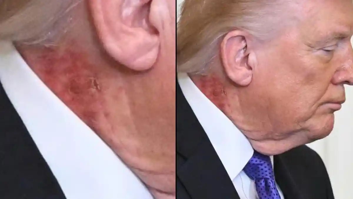 Bercak Merah di Leher Donald Trump, Dokter Beri Penjelasan