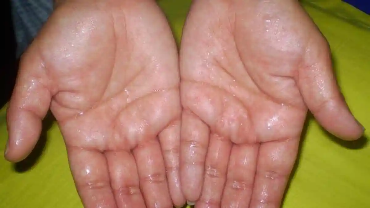 Telapak Tangan Berkeringat Tanda Paru-paru Basah, Benarkah Demikian? Begini Penjelasan Medisnya