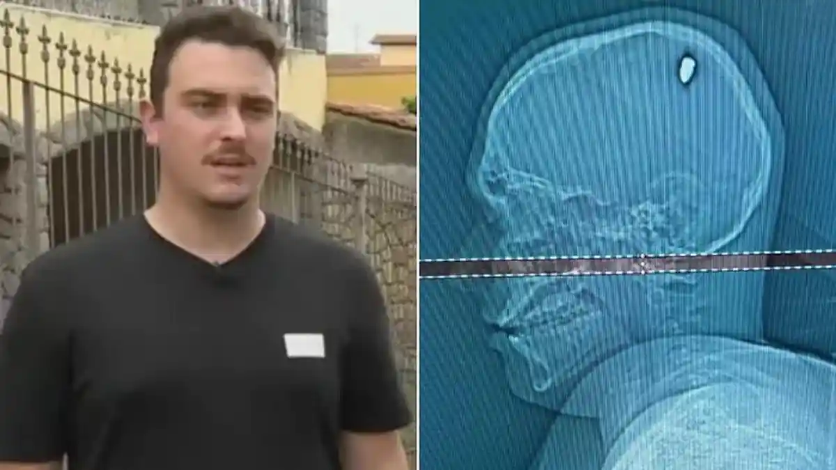 Pria Tak Sadar Ada Peluru di Kepalanya Selama 4 Hari, Dikira Kena Lemparan Batu Ternyata Tertembak