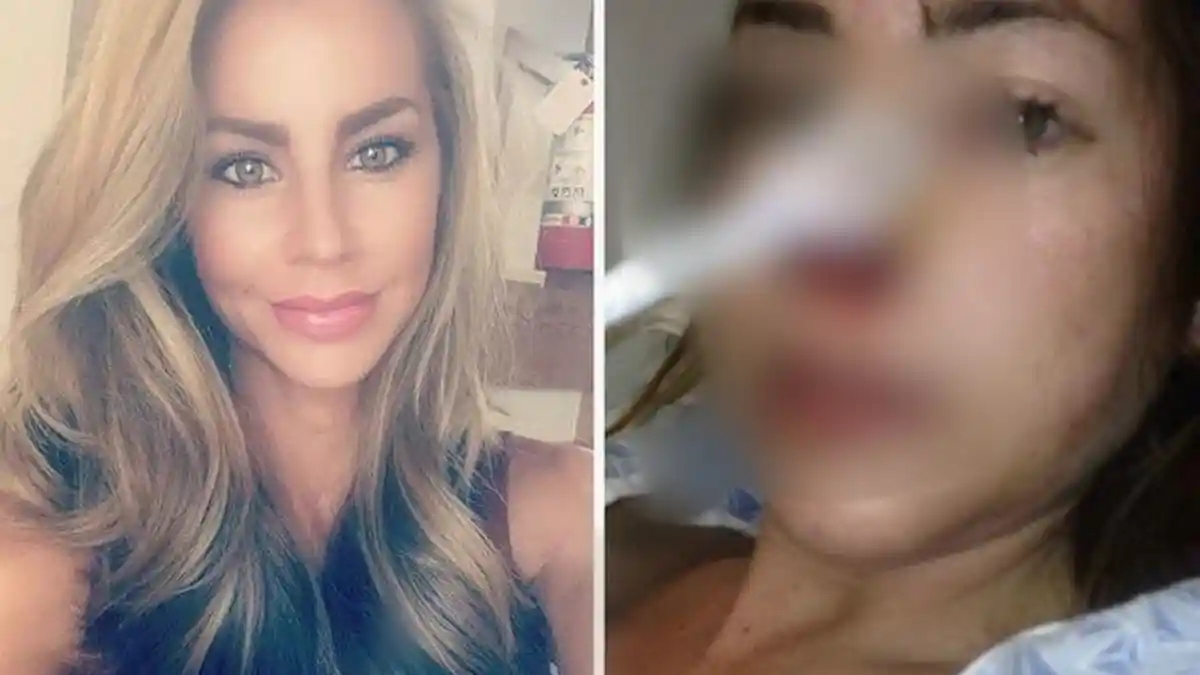 Gara-gara Kecanduan Alkohol, Model Majalah Playboy Ini Alami Komplikasi dan Kulitnya Mengelupas