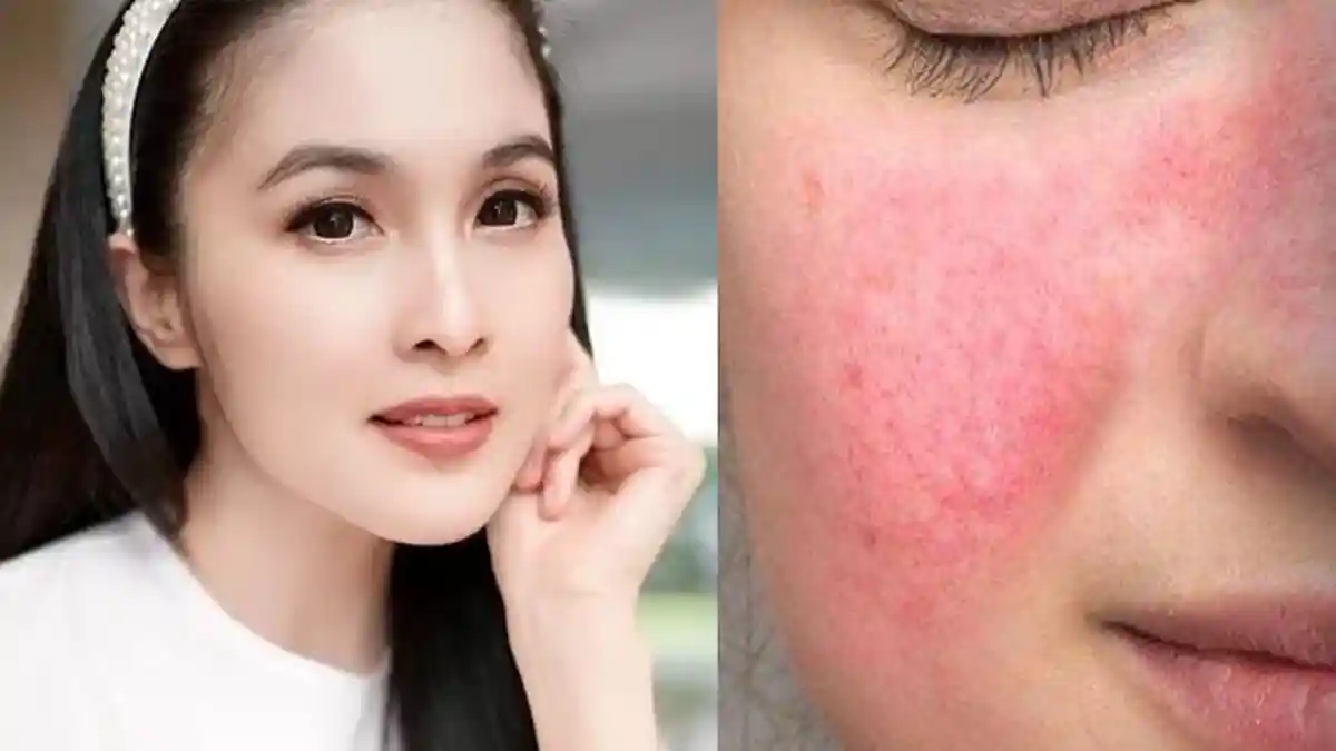 Kondisi Sandra Dewi Idap Penyakit Kulit Terungkap Saat Sidang Korupsi Harvey, Wajah Sampai Bernanah