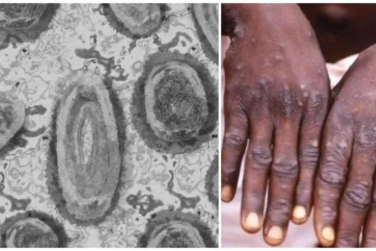 Bagaimana Cacar Monyet Menyebar? Apakah Dapat Menular Lewat Udara?