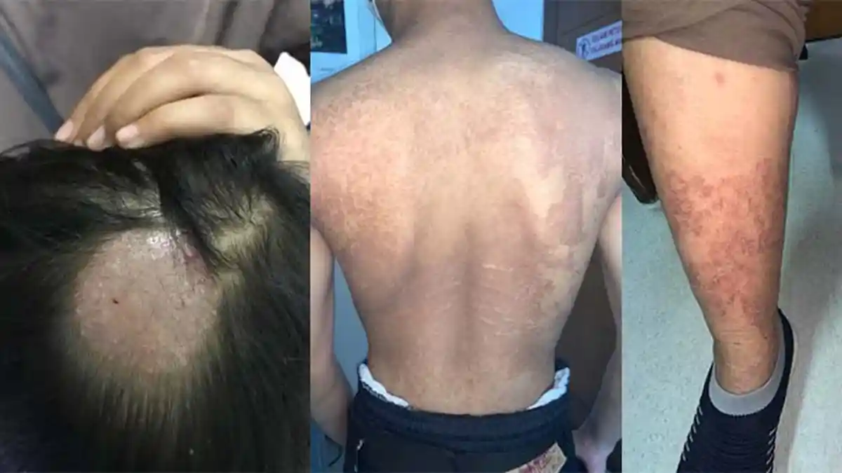 Penyakit Kulit Jamur