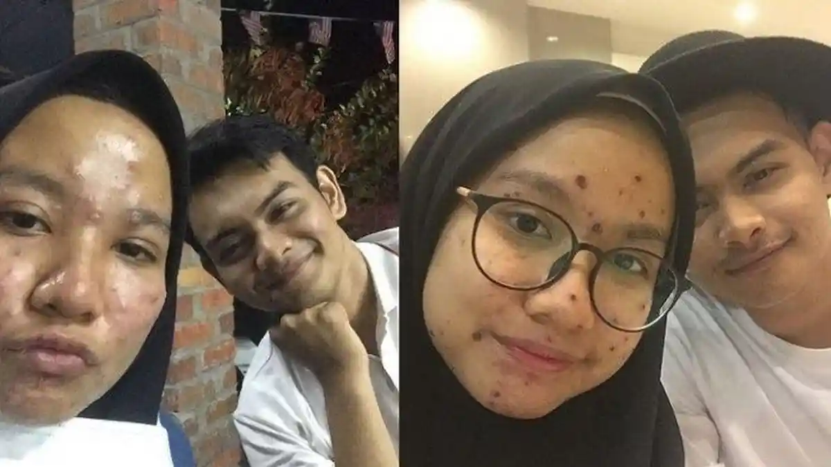 Pria Ini Posting Wajah Ceweknya yang Berjerawat, Isi Pesannya Viral, Simak 9 Tips Mencegah Jerawat