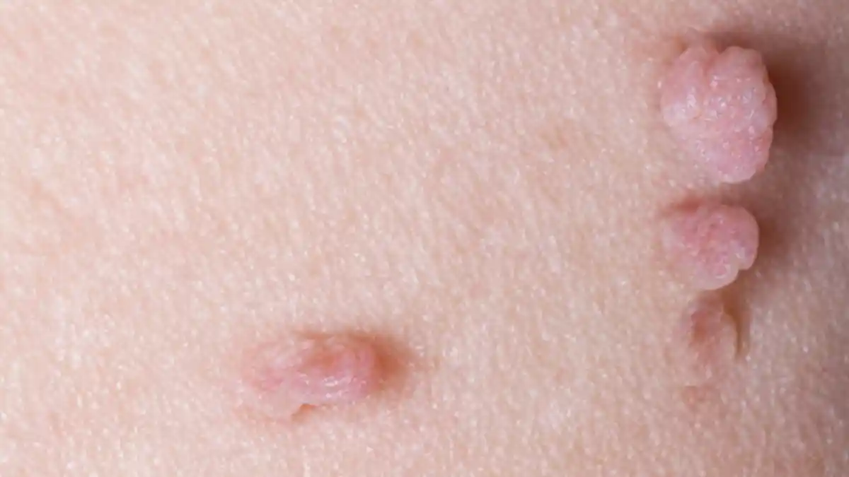 5 Cara Mudah Menghilangkan Skin Tag Atau Daging Tumbuh Secara Alami