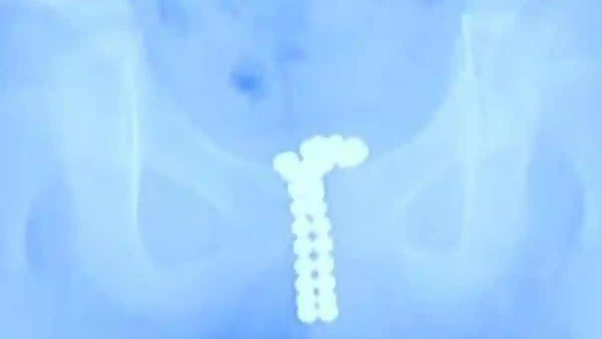 Karena Penasaran, Bocah 12 Tahun Nekat Masukkan Magnet ke Alat Kemaluannya