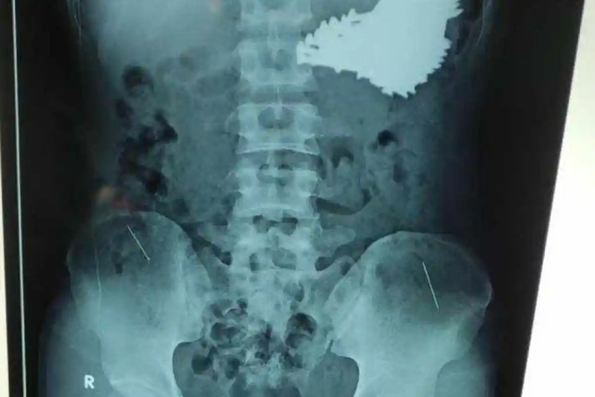 Pasien Pria ODGJ Bikin Syok Dokter, Ditemukan Ada 70 Paku di Lambung, Ternyata Imbas Kebiasaan Ini