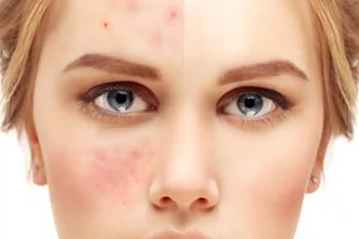 Cara Menghilangkan Beruntusan di Wajah dengan Skincare yang Tepat Menurut Dermatolog