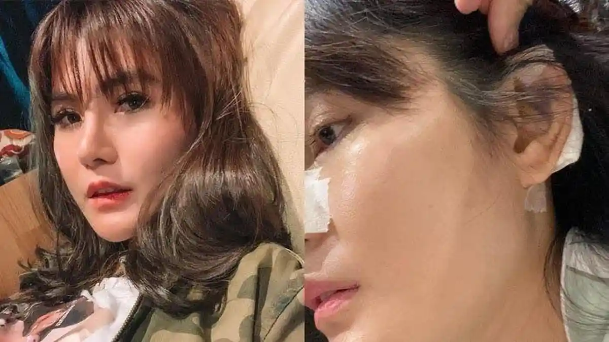 PENYESALAN Angela Lee Lakukan Operasi Plastik, Hidung Miring Gagal Dipercantik Kapok Banget