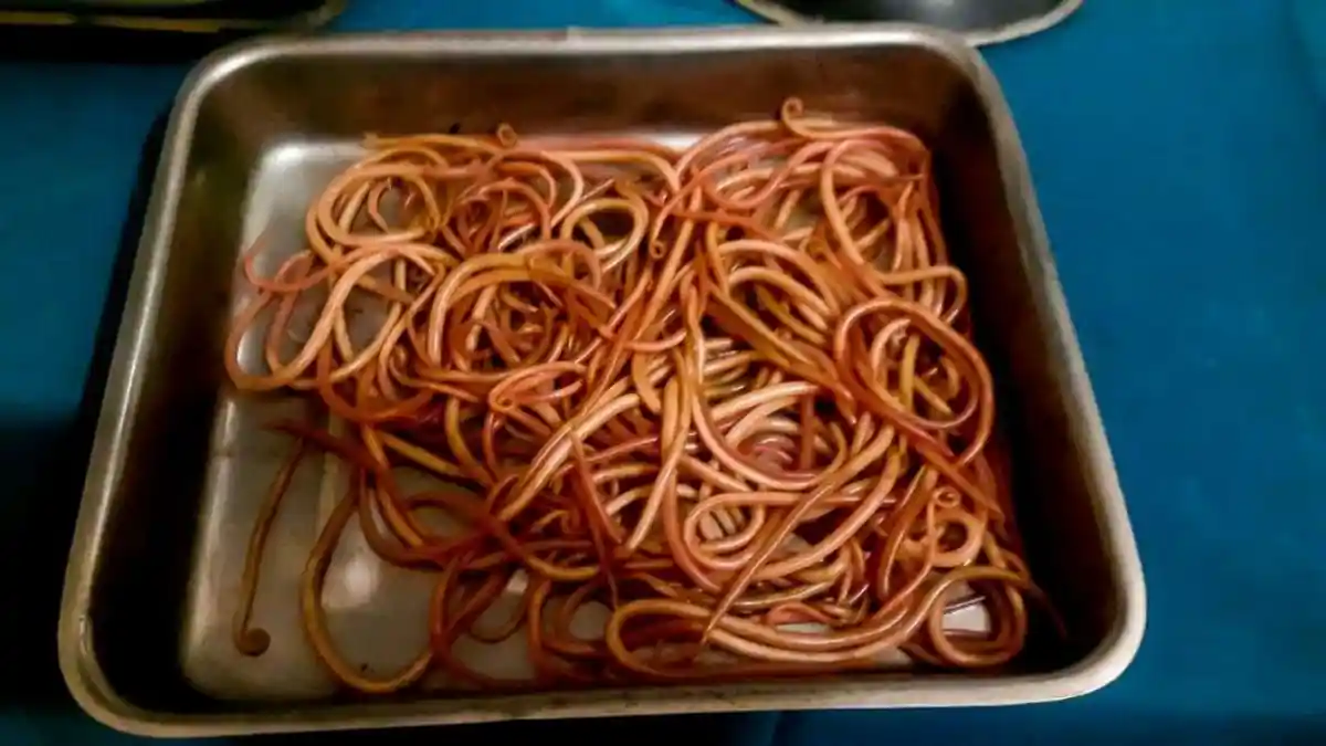 150 Cacing Gelang Hidup di Perut Perempuan Muda ini, Panjangnya Hingga 25 Sentimeter