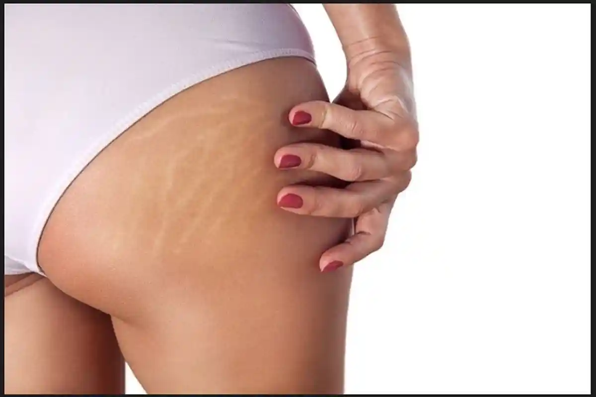 5 Ramuan Tradisional Berkhasiat Hilangkan Stretch Mark Secara Alami, Sudah Tahu?