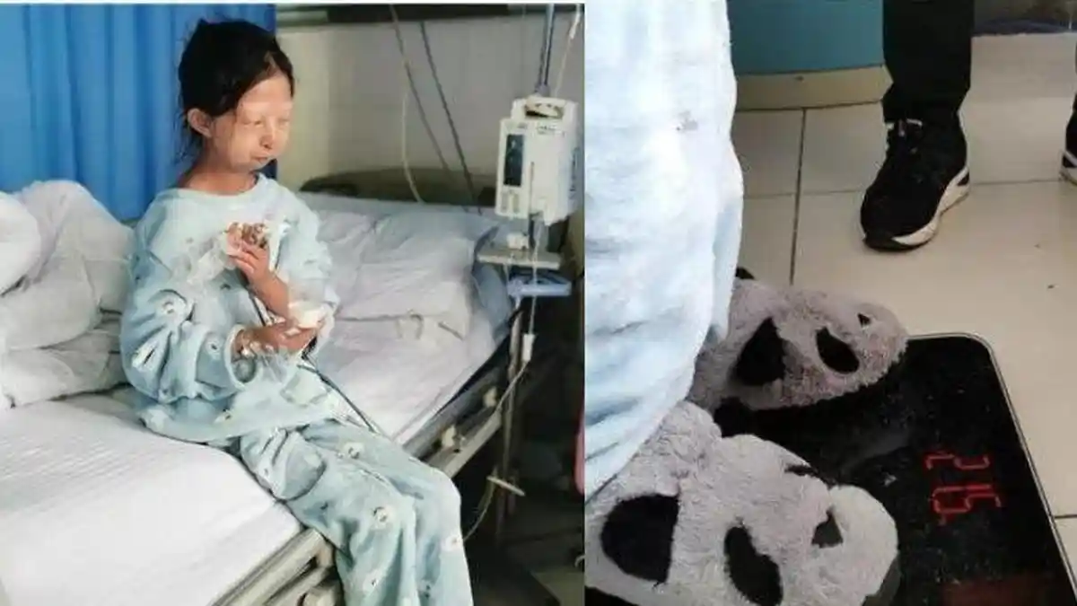 Berhemat Demi Pengobatan Sang Adik, Berat Badan Gadis 24 Tahun Ini Tinggal 24 Kg