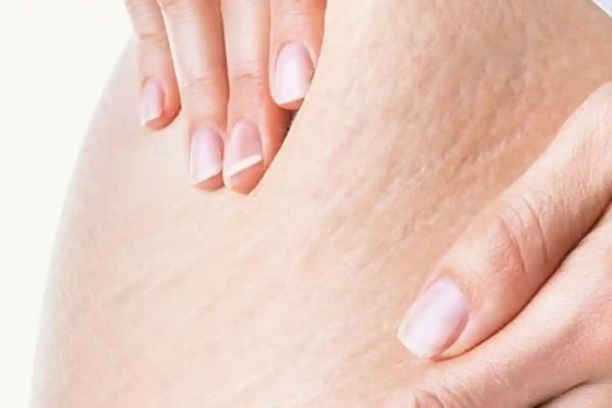 Nggak PD Punya Stretch Mark? 5 Cara Ini Ampuh Mengatasinya