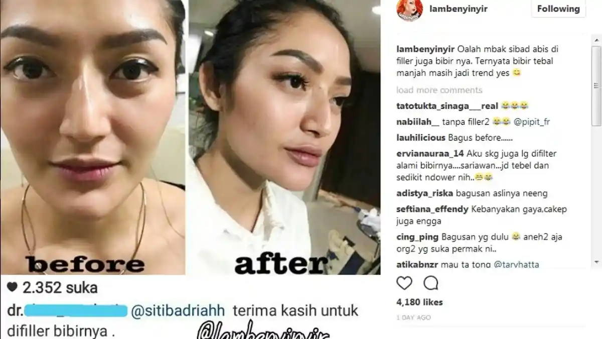 Heboh Kabar Siti Badriah Filler Bibir Hingga Diserbu Netizen 'Jadi Jeber'