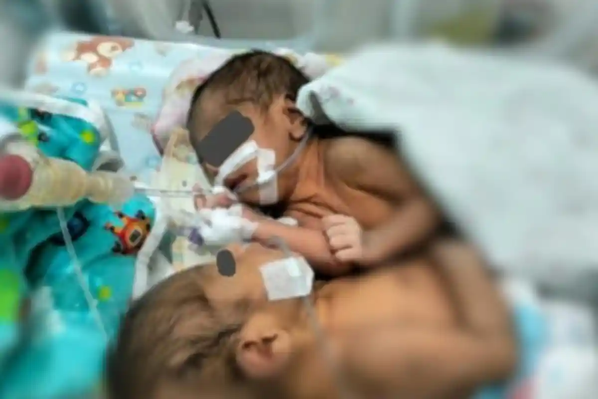 Libatkan Tim Medis Surabaya, Bayi Kembar Siam di Larantuka Flores Timur Segera Dioperasi