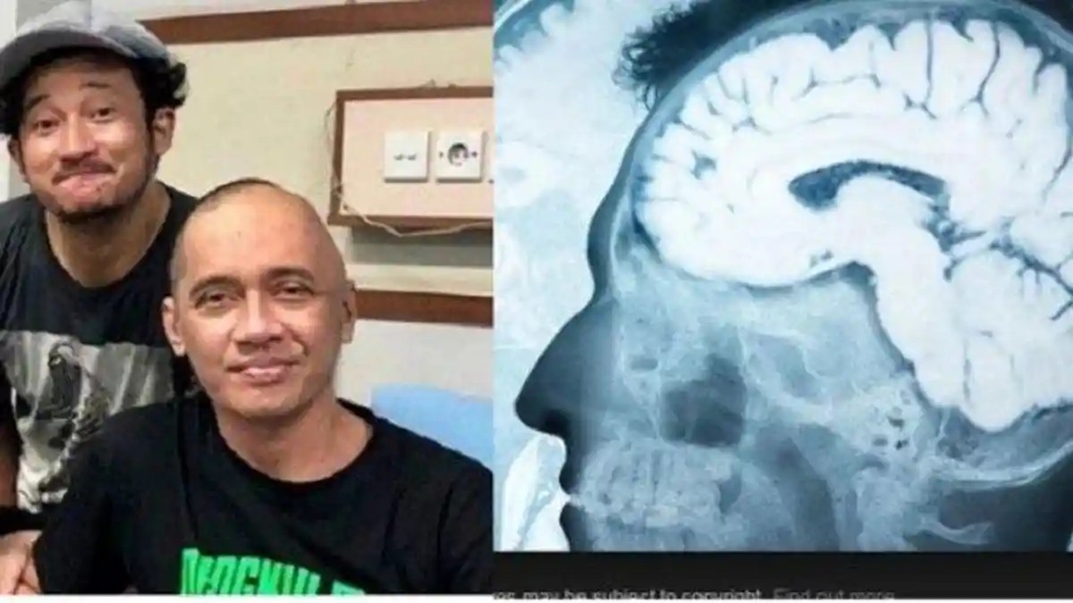 Agung Hercules Tak Bisa Dikemoterapi, Sempat Hilang, Tumor di Otaknya Muncul Lagi