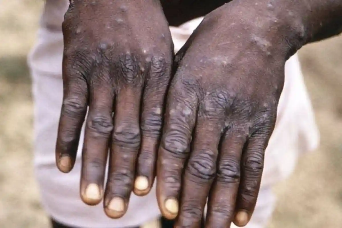 Apa itu Cacar Monyet Penyakit Langka yang Muncul di Amerika Serikat ? Apa Gejala Cacar Monyet ?