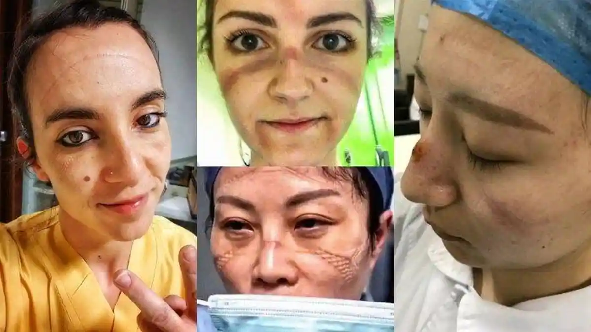 Di Balik Tegarnya Dokter & Perawat Hadapi Pasien Corona, Lihat Wajah-wajah Lebam Berdarah Ini, Sedih