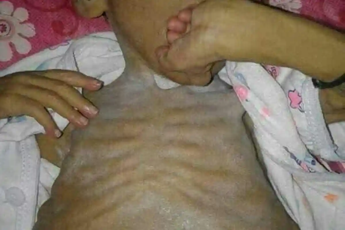 Sejak Lahir Bocah 4 Tahun di Polman Ini Gizi Buruk, Ayo Bantu!