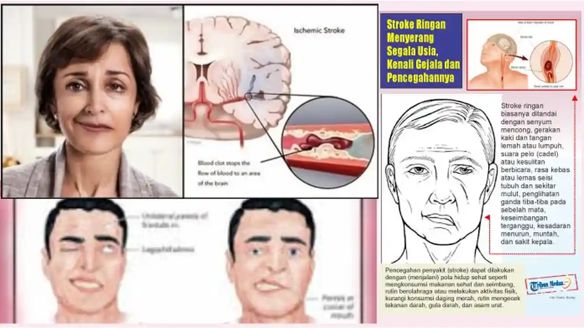 Stroke Ringan Bisa Menyerang Segala Usia, Kenali Gejala dan Pencegahannya