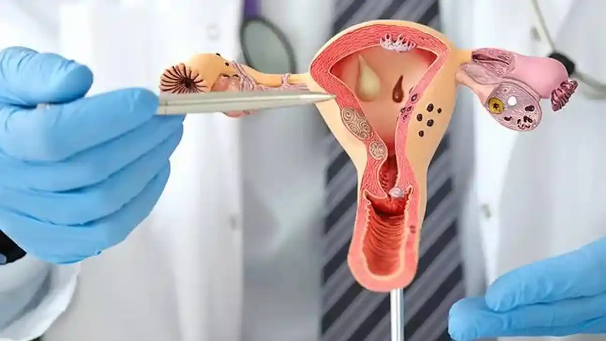 Arti PCOS Pada Wanita, Diyakini Dapat Menganggu Siklus Menstruasi dan Kehamilan