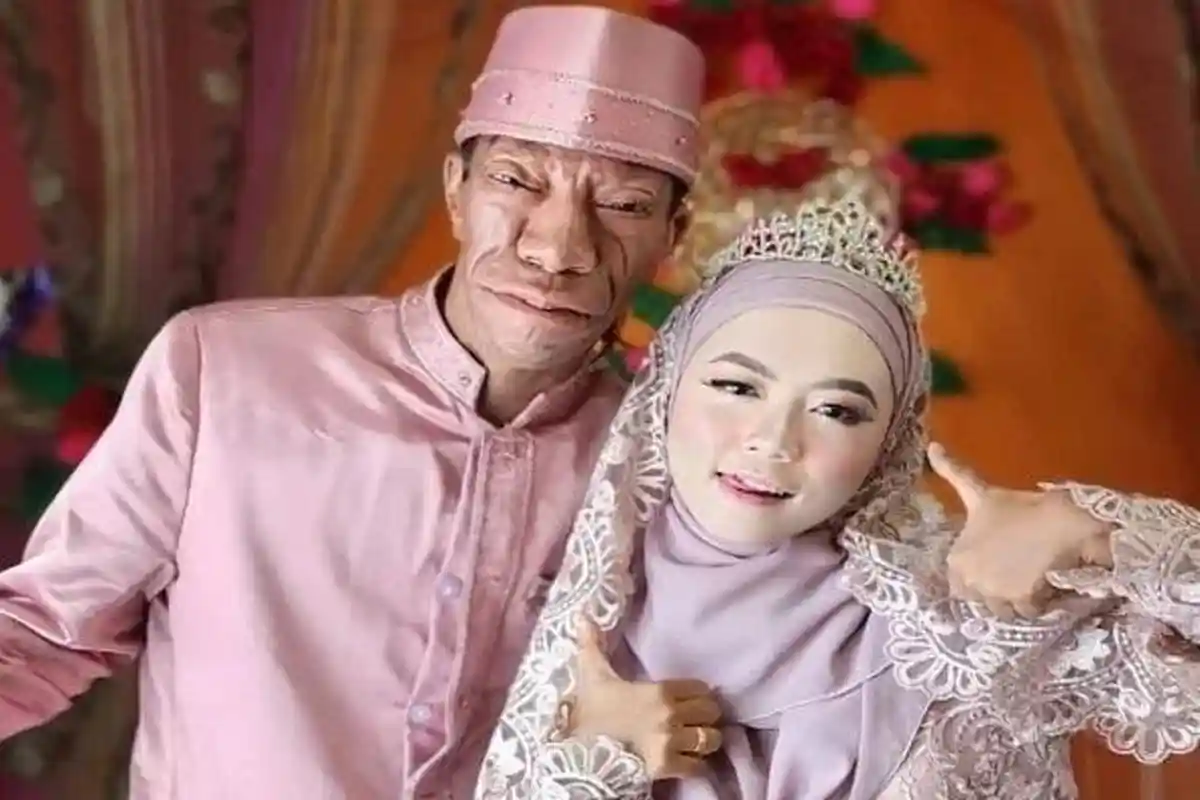 Siapa Surya Manarung? TikTokers Pengidap Sindrom Langka yang Kini Nikahi Gadis Cantik