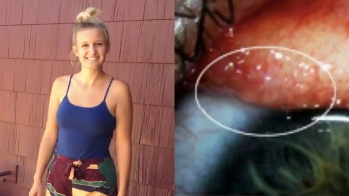 Dikira Bulu Mata Nyangkut Tapi Saat Ditarik Ternyata Ada Banyak Hewan Menjijikkan di Mata Wanita Ini