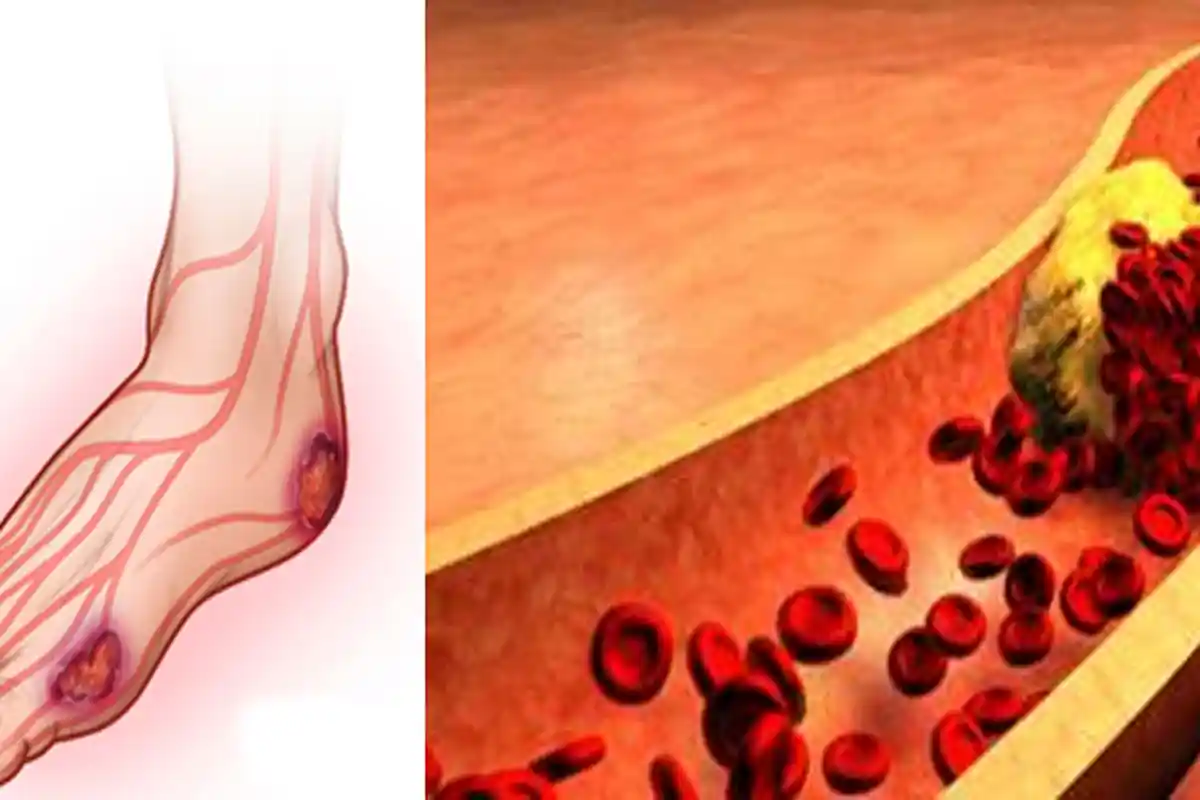 Jangan Disepelekan 6 Tanda Ini Tunjukkan Anda Terkena Diabetes, Ini Gejala Saat Kelebihan Kadar Gula