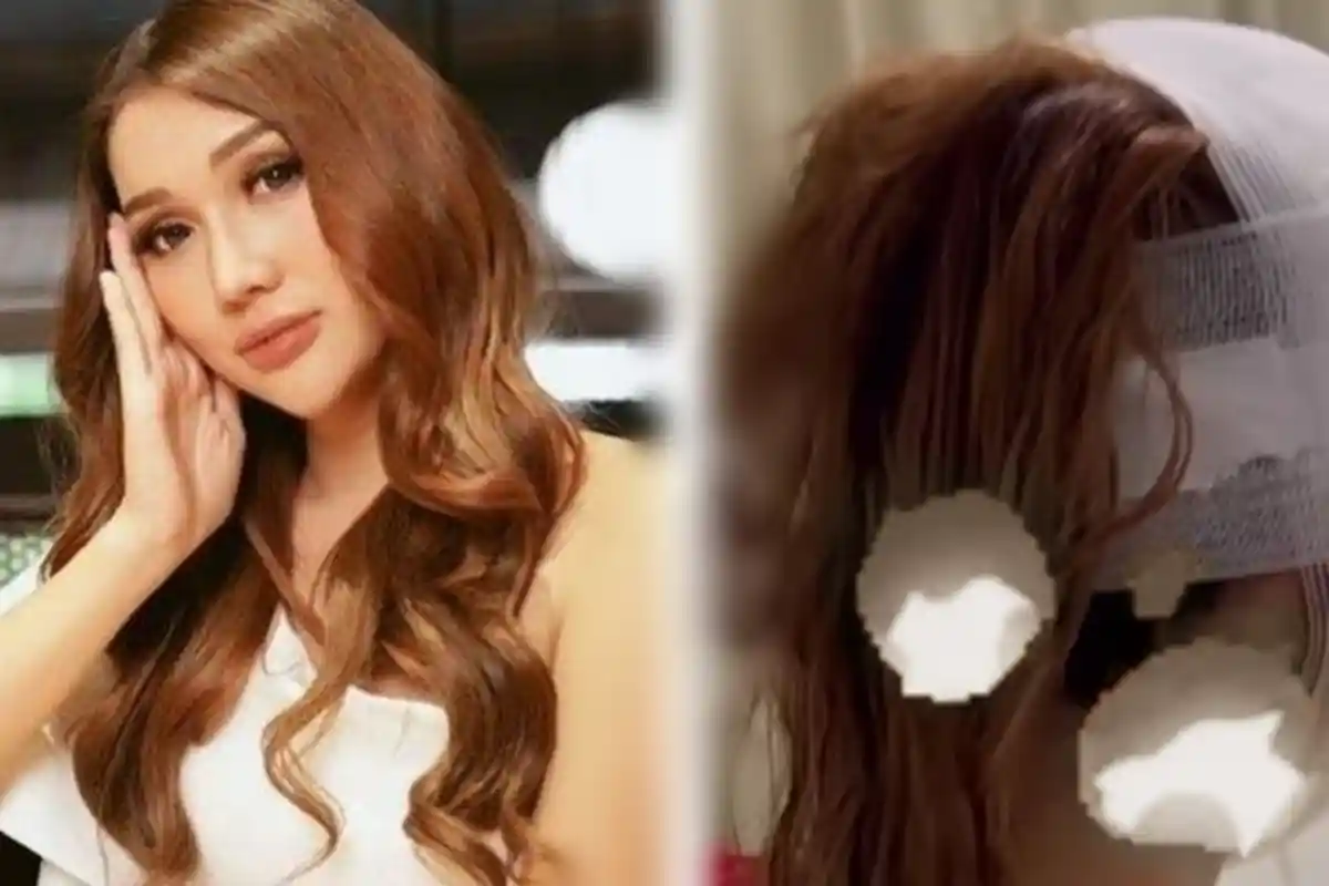 Akhirnya Terungkap, Ternyata Segini Biaya Operasi Plastik Lucinta Luna