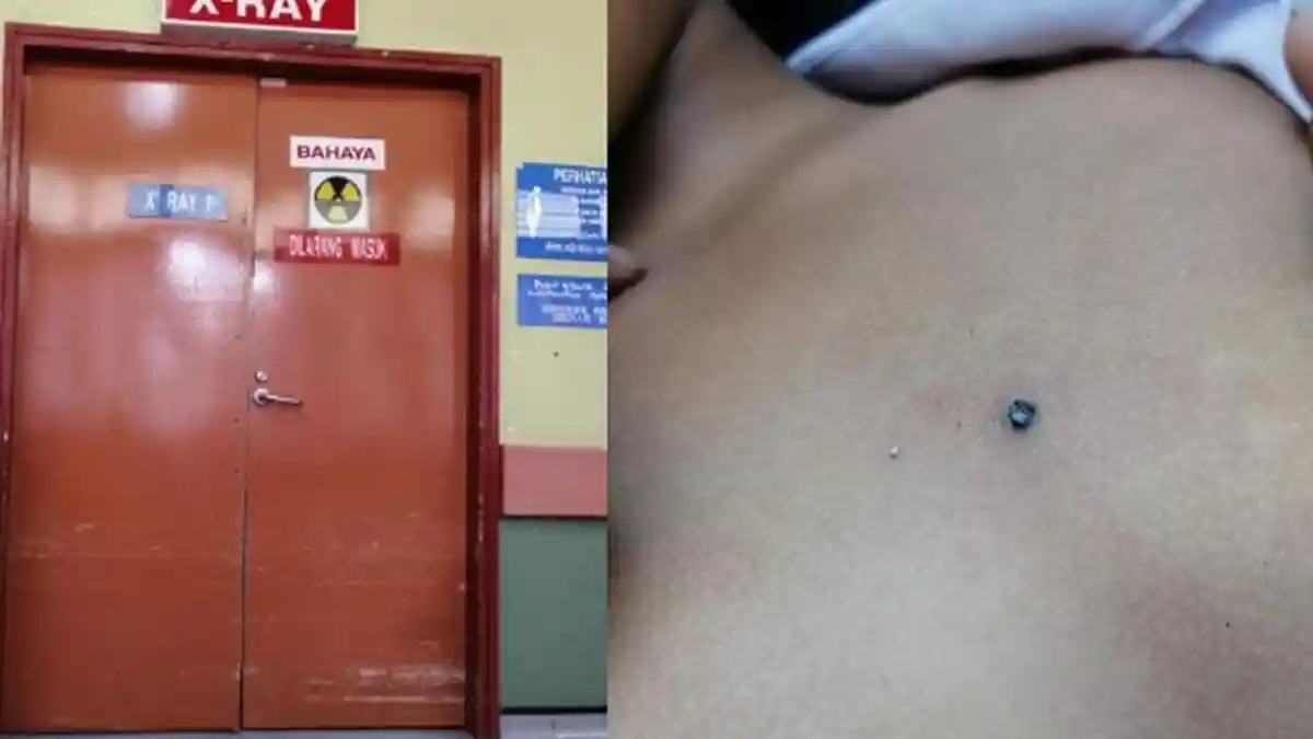 Jadi Koban Bully, Seorang Bocah Dianiaya Teman Kelasnya Hingga Ujung Pencil Menancap di Dada