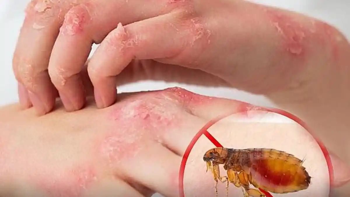 Mengerikan, Bermula Digigit Kutu, Kedua Lengan Pria Ini Harus Diamputasi setelah Dirawat 11 Hari