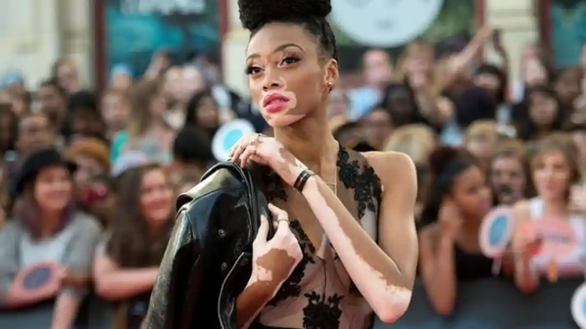 Meski Alami Kulit Belang atau Vitiligo, Wanita Ini Terus Mengejar Mimpinya, Jadi Top Model Dunia