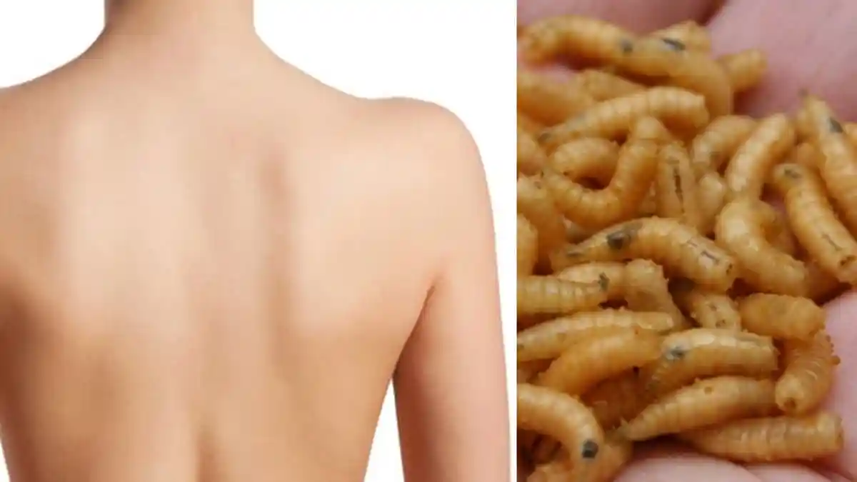 Pengalaman Ngeri Wanita Mengeluh Gatal di Punggung, Setelah 8 Minggu Keluar Belatung dari Kulit