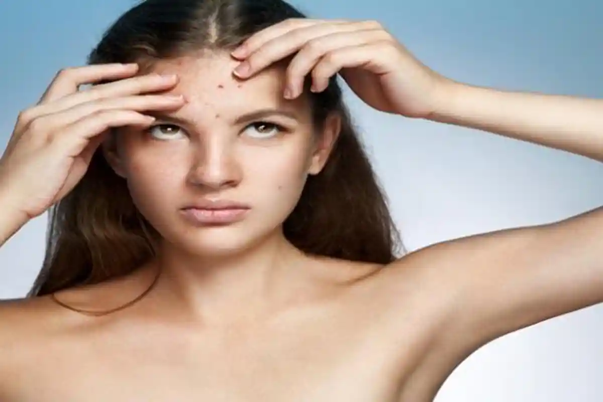 Jangan Samakan Pengobatan Jerawat di Wajah dengan di Punggung, Ini Penjelasannya