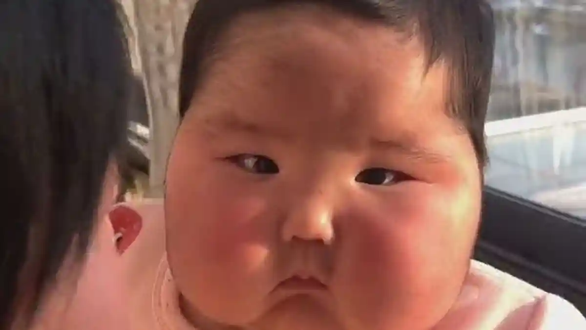 Setelah Dikasih Krim Steroid, Pipi Bayi Ini Menggelembung dan Tumbuh Rambut