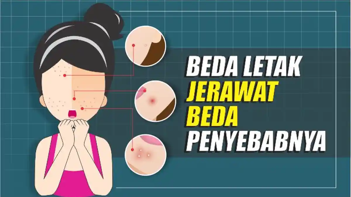 Halo Dokter, Apa Itu Jerawat dan Jenis-jenisnya