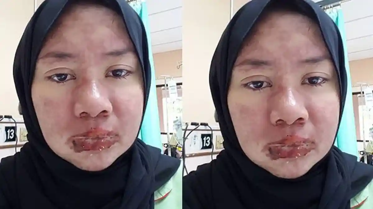 Sarat Nestapa, Simak Curhatan Wanita yang Mengidap Penyakit Langka